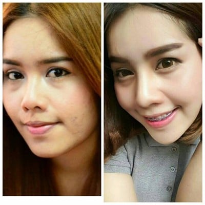 เสริมจมูก