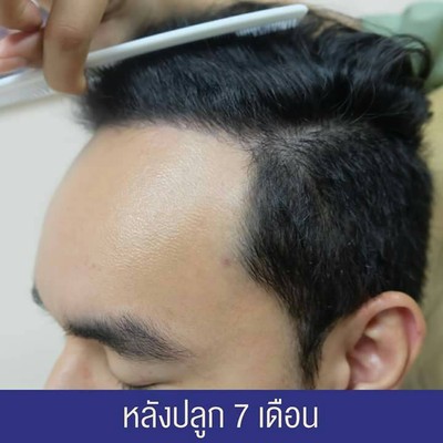Dr.ORN Hair transplant center