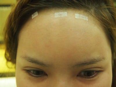 ฉีดไขมัน