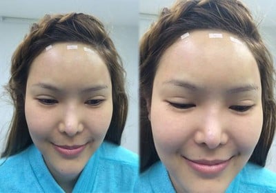 ฉีดไขมัน