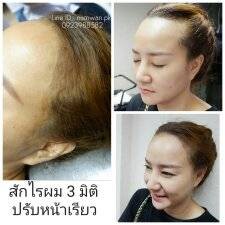 สักไรผมเสมือนจริง แก้ปัญหาหน้าไม่สวย ปรับหน้าเรียวได้