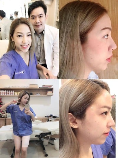 รีวิวเติมไขมันหน้าเด็ก