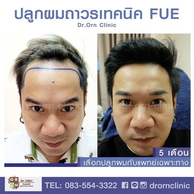 ปลูกผมถาวร
