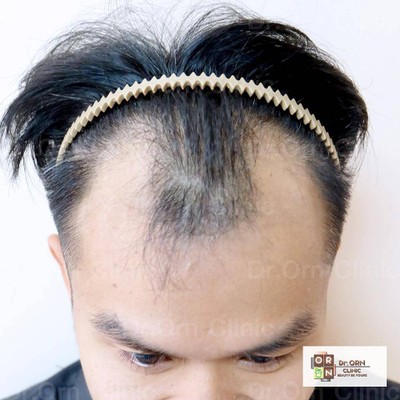 à¸£ à¸§ à¸§ Dr Orn Hair Transplant Center à¸­ à¸žà¹€à¸