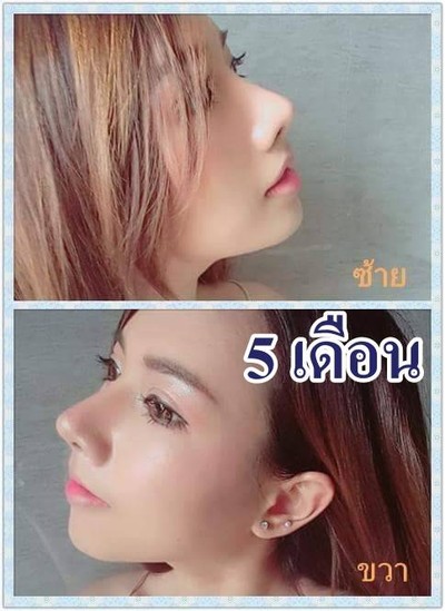 กรีดตาสองชั้นแบบยาว