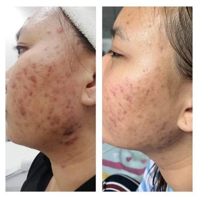Barrier Repair , Molecular Bright, Acne Skin Reactivating Treatment