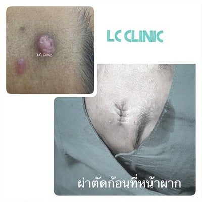 ผ่าตัดก้อนที่หน้าผาก (ก้อนที่ผิวหนัง) ในโคราช แอลซีคลินิก