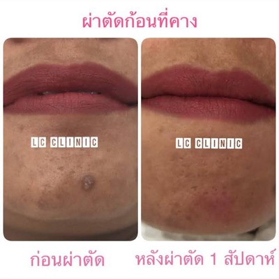 ผ่าตัดเล็ก