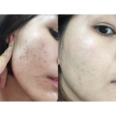 เลเซอร์และทรีทเมนท์