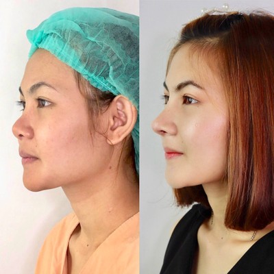 เสริมจมูก Recons