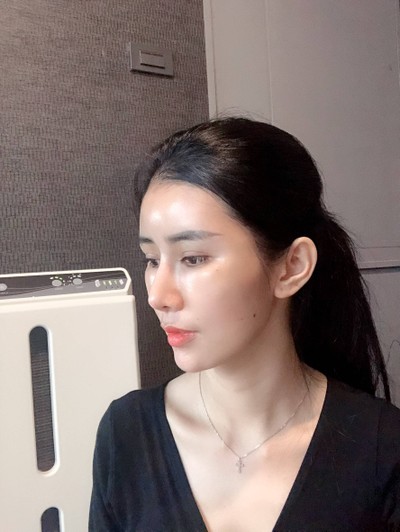 เติมไขมันหน้า