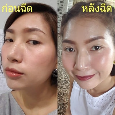 รีวิว Divadi Clinic ดีว่าดี คลินิก สระบุรี - Volite เติมน้ำให้ผิว  ดีขั้นสุดสำหรับผิวหน้า