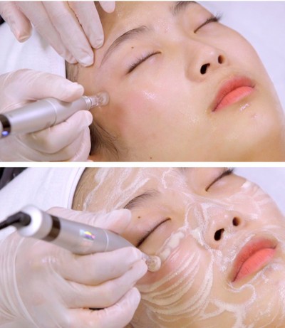 MTS (Microneedle Therapy System)  1 ครั้ง ราคาปกติ 2,500 เหลือเพียง 1,599 บาทเท่านั้น