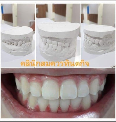 กรณีศึกษา เคส ฟันล่างคร่อมฟันบน จัดฟันไม่ต้องผ่าตัด #คลินิกสมควรทันตกิจ #จัดฟันป