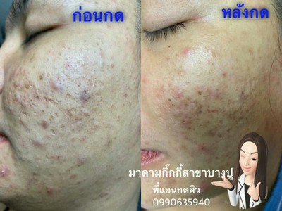 ดูแลหน้ากดสิว (พี่กุ้งกดสิวสาขาบางปู) บางปู ดูแลหน้ากดสิว (พี่กุ้งกดสิวสาขาบางปู) บางปู