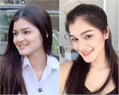 ฟิลเลอร์คาง