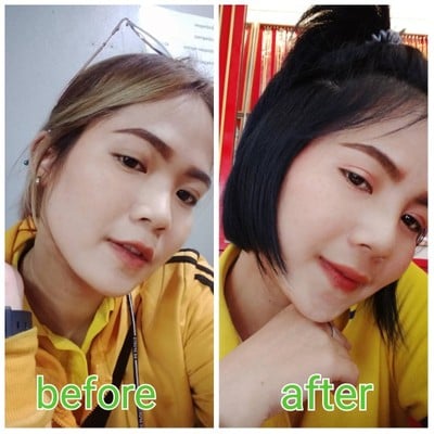 เสริมจมูก