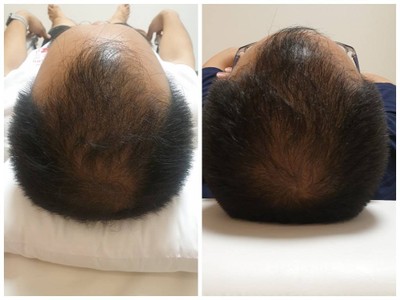 PRP เส้นผม