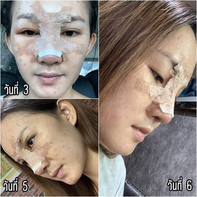 เสริมจมูก