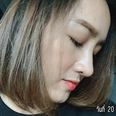 เสริมจมูก