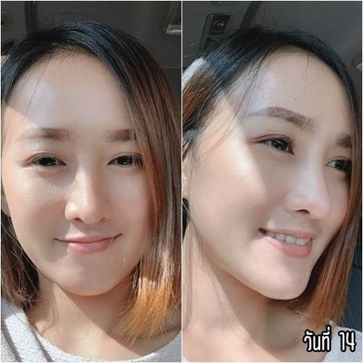 เสริมจมูก