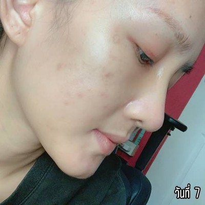 เสริมจมูก