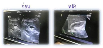 หมอนวดแก้อาการจับเส้น มือแข็ง เชี่ยวชาญงานแก้เส้น พังผืด