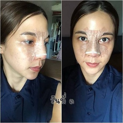 เสริมจมูก