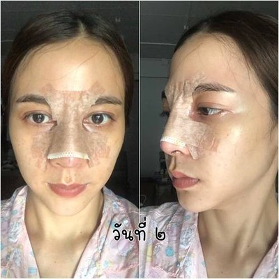 เสริมจมูก