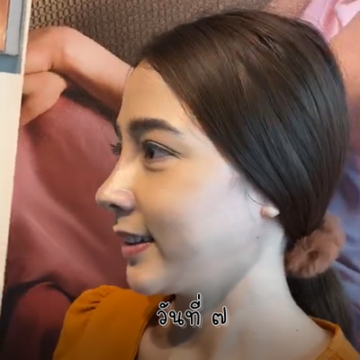 เสริมจมูก