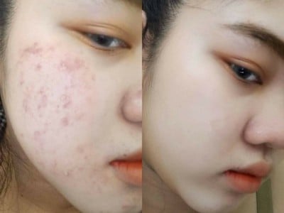 M Vita Clinic - คลินิกรักษาสิว Asoke Montri