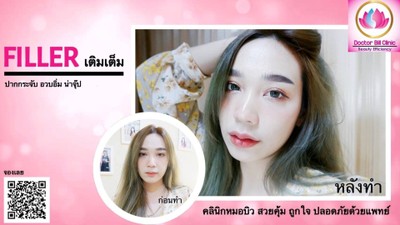 Filler เติมเต็มปากอวบอิ่ม น่าจุ๊ปๆๆ
