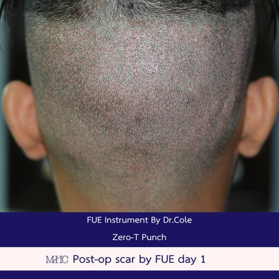 Million Hair Transplant Center