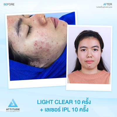 รีวิวรักษาสิว