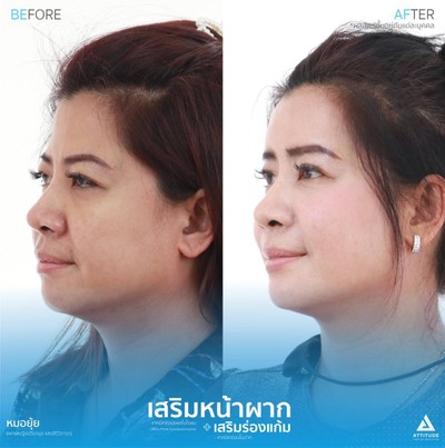 รีวิวเสริมหน้าผากและเสริมร่องแก้ม