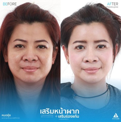 รีวิวเสริมหน้าผากและเสริมร่องแก้ม