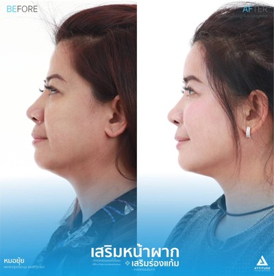 รีวิวเสริมหน้าผากและเสริมร่องแก้ม
