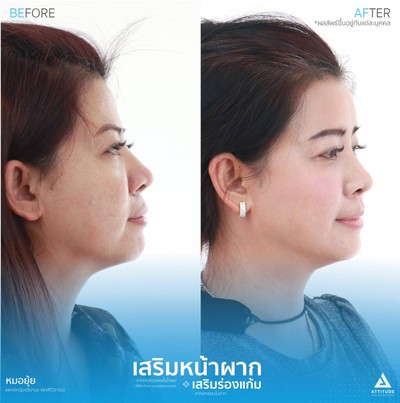 รีวิวเสริมหน้าผากและเสริมร่องแก้ม