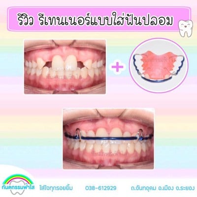 รีเทนเนอร์ ใส่ฟันปลอม