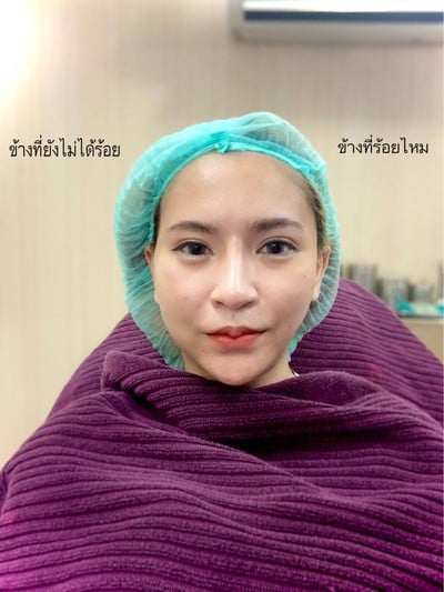 จะเห็นว่าข้างที่ร้อยแล้ว ดูกระชับ หน้าเรียวสวยขึ้นทันทีเลยค่ะ 