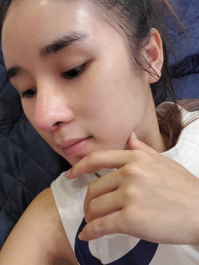 แก้จมูก Recons