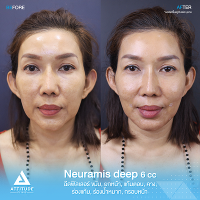 รีวิวฉีดฟิลเลอร์