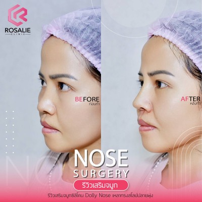 รีวิวเสริมจมูก