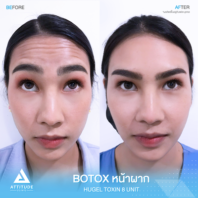 รีวิวฉีดโบท็อกซ์