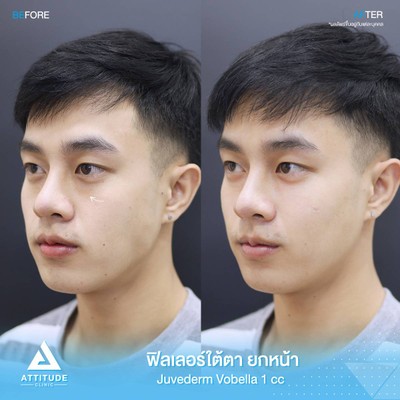 รีวิวฉีดฟิลเลอร์ใต้ตา