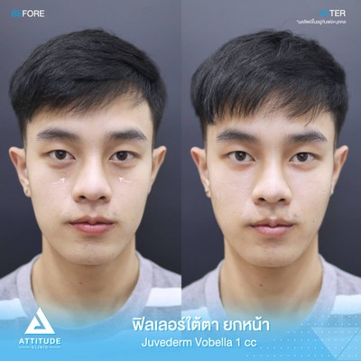 รีวิวฉีดฟิลเลอร์ใต้ตา