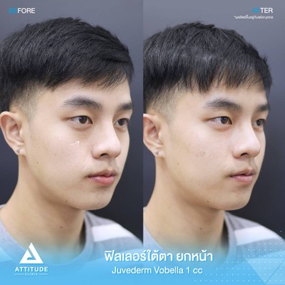 รีวิวฉีดฟิลเลอร์ใต้ตา