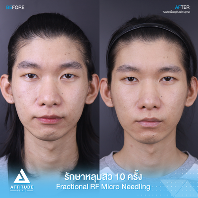 รีวิวรักษาหลุมสิว