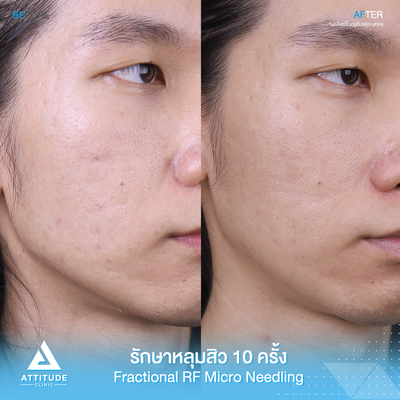 รีวิวรักษาหลุมสิว