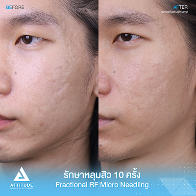 รีวิวรักษาหลุมสิว